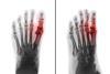 Film x-ray of human foot and arthritis at first metatarsophalangeal Joint . 2 position ( front and side view )